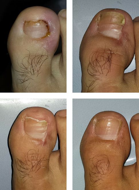 Clínica Podológica Sala uñas y dedos de pies